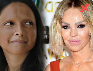 Acid attack survivor Katie Piper tweets about Chhapaak movie trailer